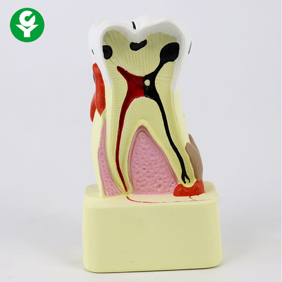 Karies-Vergleichs-modelliert zahnmedizinisches Zahn-Modell/zahnmedizinische Demonstration für das Unterrichten