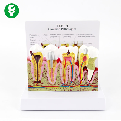 Periodontaler zahnmedizinischer Zahn-Modell-menschlicher medizinischer Zerfall-allgemeine Pathologie-Anzeige